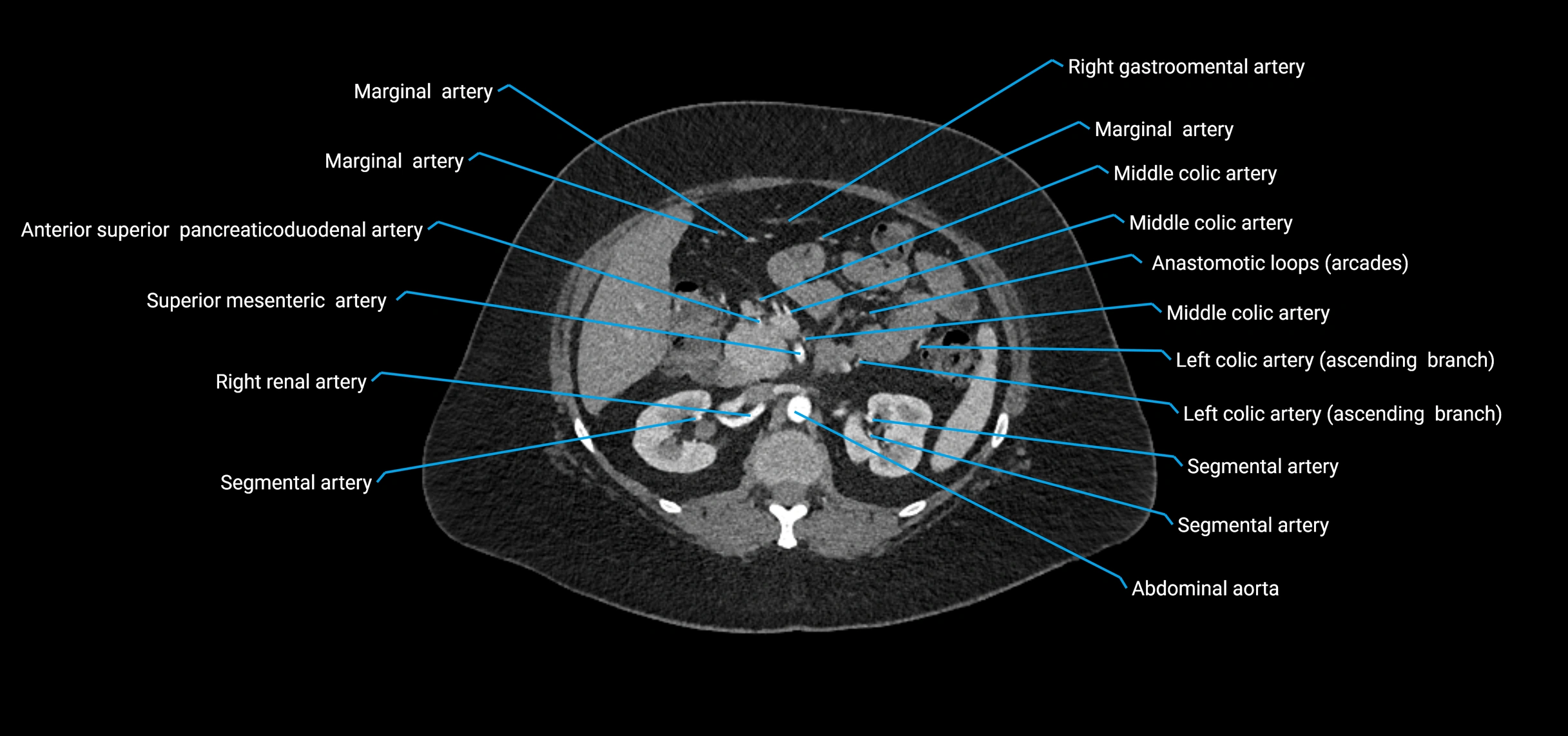 CTA abdomen axial cross sectional anatomy labelled image_69 (2).webp